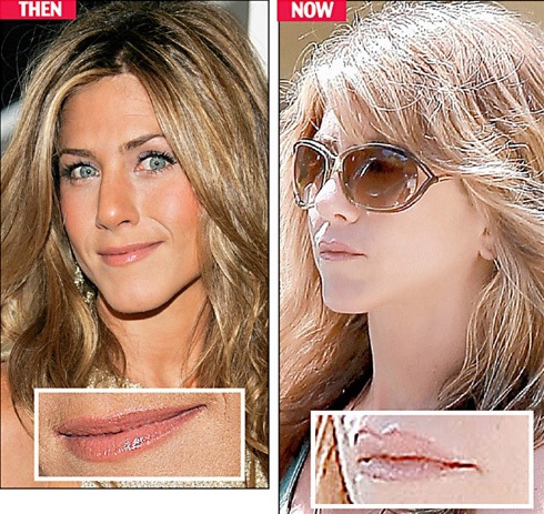 Starchirurgie: Jennifer Aniston