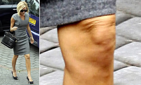 Stars mit Cellulite: Victoria Beckham und Cellulite