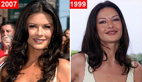 Schnheitschirurgie der Stars: Catherine Zeta-Jones